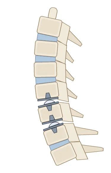 Animation of cervical disc replacement: two artificial discs allow the neck to bend forward and back
